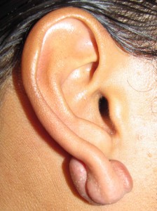 Keloid earlobe 2