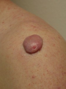Keloid On Shoulder