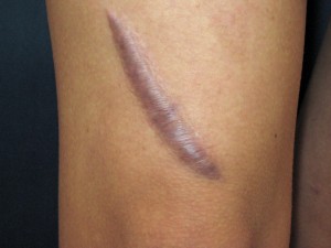 Steroid injection for keloid scars