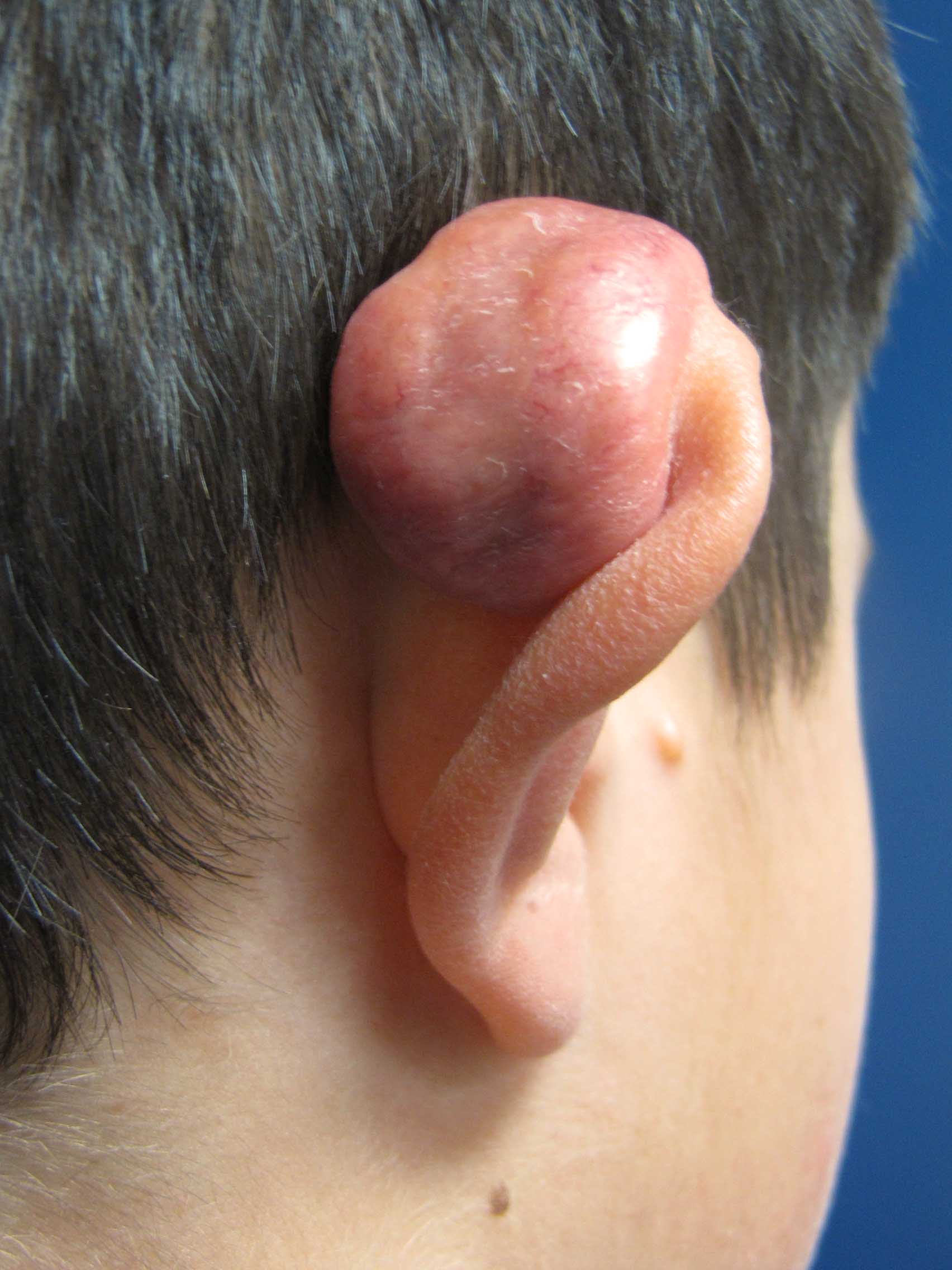 Keloid in Adults: Condition, Treatments, and Pictures ...
