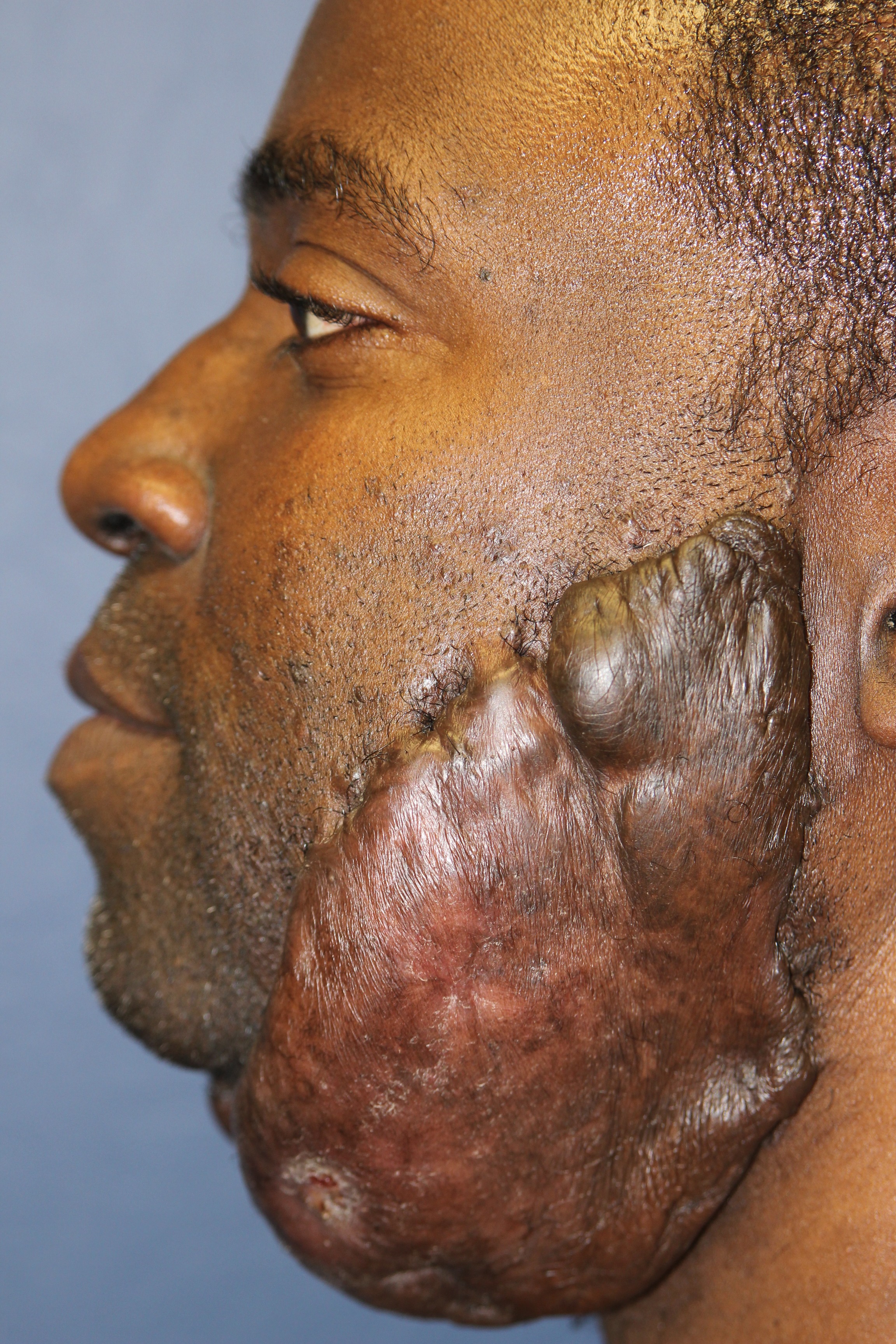 Keloids: MedlinePlus Medical Encyclopedia