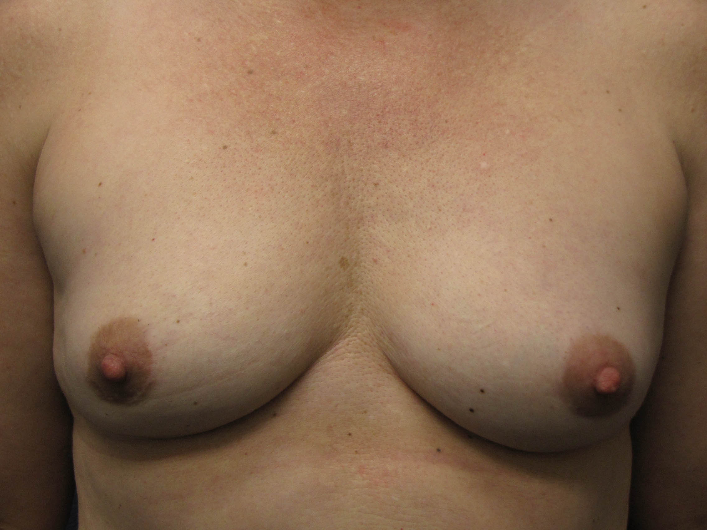 An Uncommon Form Of Breast Revision Surgery: Permanent Removal of the Breas...