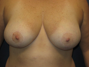 Breast Reduction - After