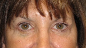 After eyelid surgery and endoscopic forehead lift