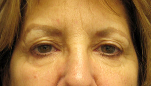 Before eyelid surgery and endoscopic forehead lift