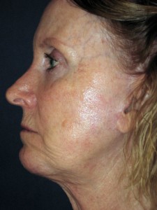 After chin augmentation