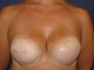 After Breast Reconstruction - Frontal view