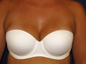 After Breast Reconstruction - Frontal view in bra