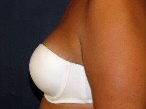 Following Breast Reconstruction - Side view in bra