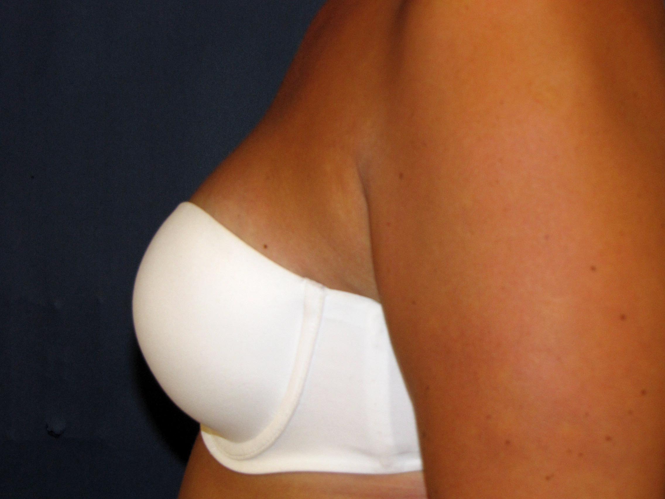 Effectiveness satisfaction breast reduction Scottsdale Mesa