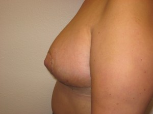 Immediately following Breast Reduction - Side view