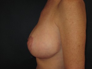 T shaped mastopexy RL post