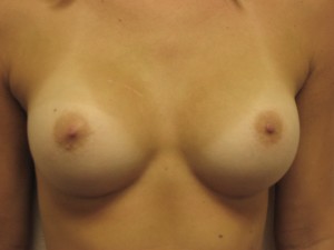 Implants behind the muscle. Note the more natural shape and smoother curves