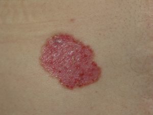 basal cell carcinoma