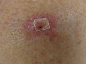 basal cell carcinoma