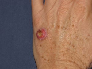 squamous cell carcinoma