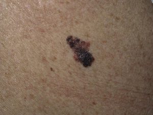 melanoma