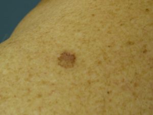 melanoma