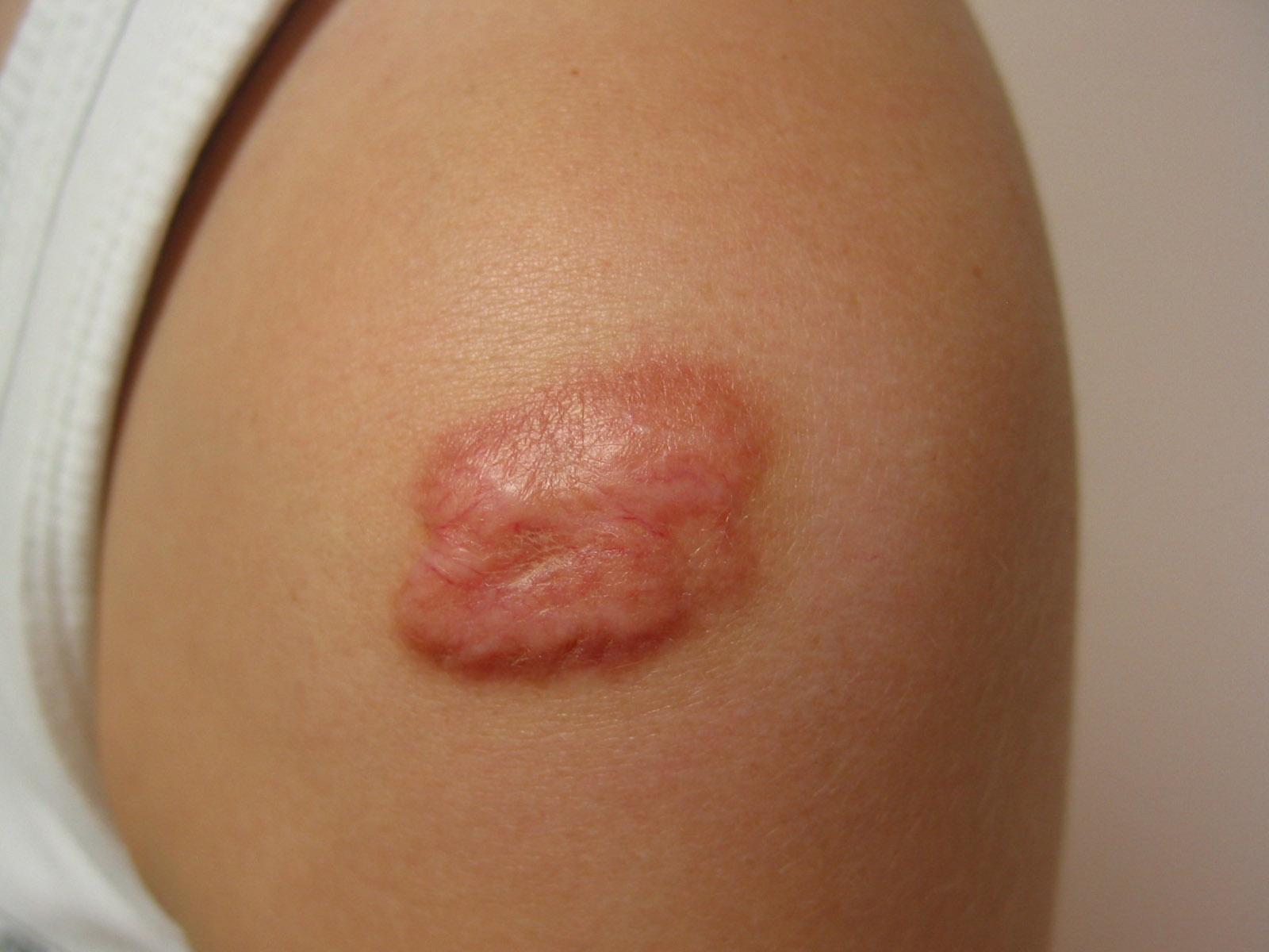 keloid scar pictures