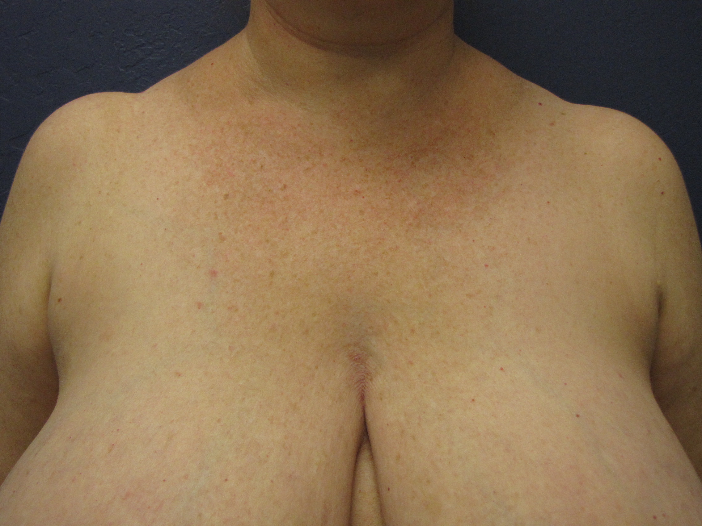Breast reduction shoulder grooving Scottsdale Phoenix Arizona