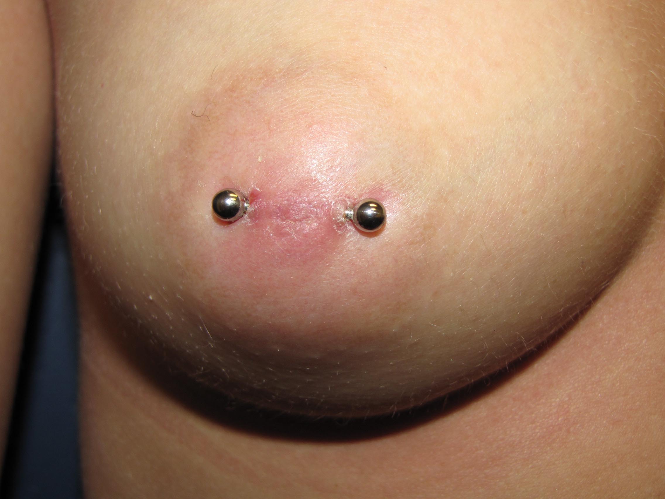 C.) Pierced inverted right nipple.