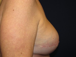 F) After right breast reconstruction revision and left breast lift