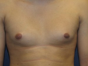 Gynecomastia 200