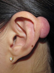 Fig. A.  Keloid of left ear