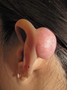 Fig. C.  Keloid before surgery