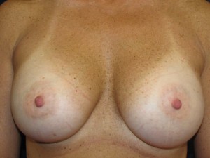 Ten years after breast augmentation - frontal view