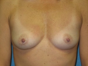 Before breast augmentation with saline implants