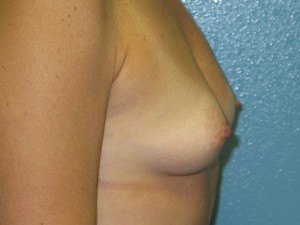 Before breast augmentation