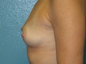 Before breast augmentation
