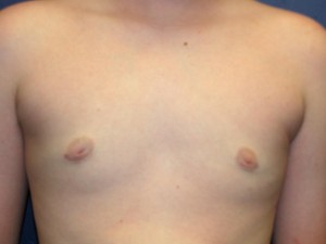After plastic surgery treatment