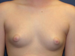 13 year old with prominent gynecomastia