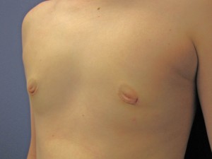 F) After surgery - oblique view