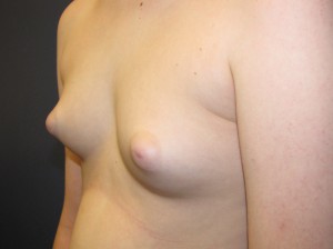 E) Before surgery - oblique view