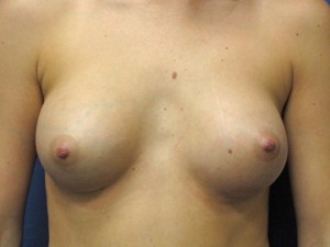 B) after breast augmentation