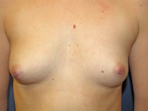 A) before breast augmentation