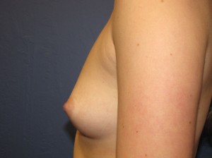 C) before surgery - side view