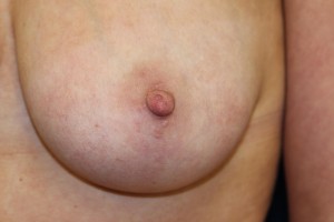 After treatment of inverted nipple
