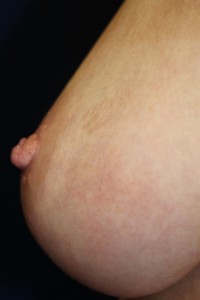 After surgical release of inverted nipple