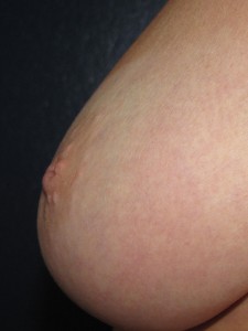 Inverted left nipple - side view