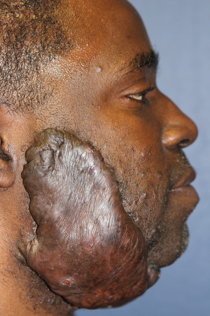 Giant relapsing earlobe keloid – Successful combined treatment by