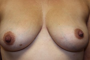 F) After plastic surgery correction of inverted left nipple