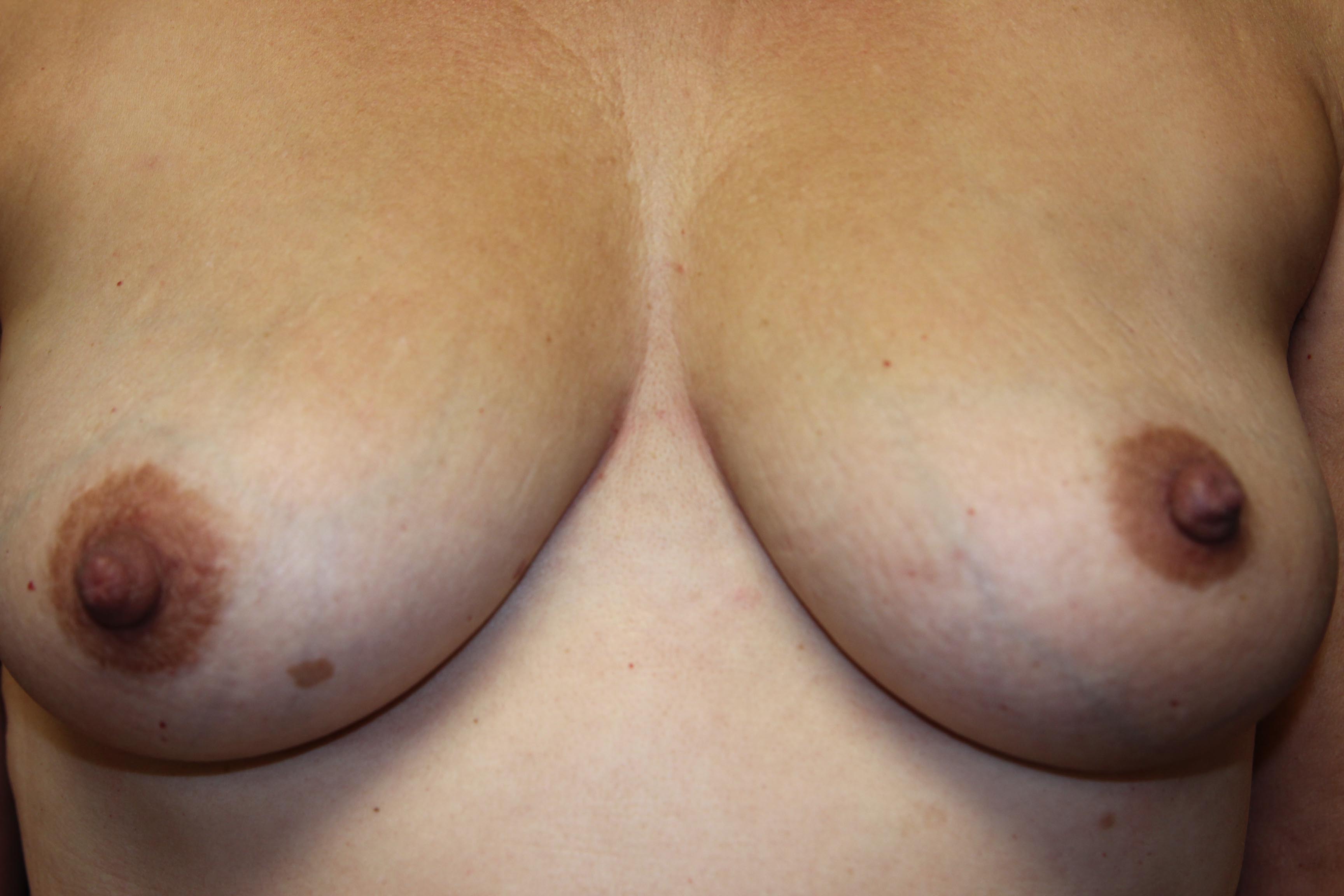A guide to the risks of having breast surgery abroad
