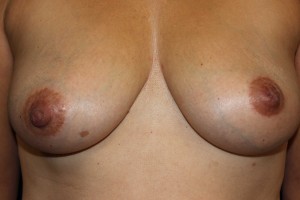 E) Before surgical correction of inverted left nipple