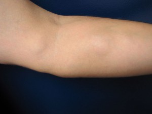 Multiple lipomas of left arm and forearm