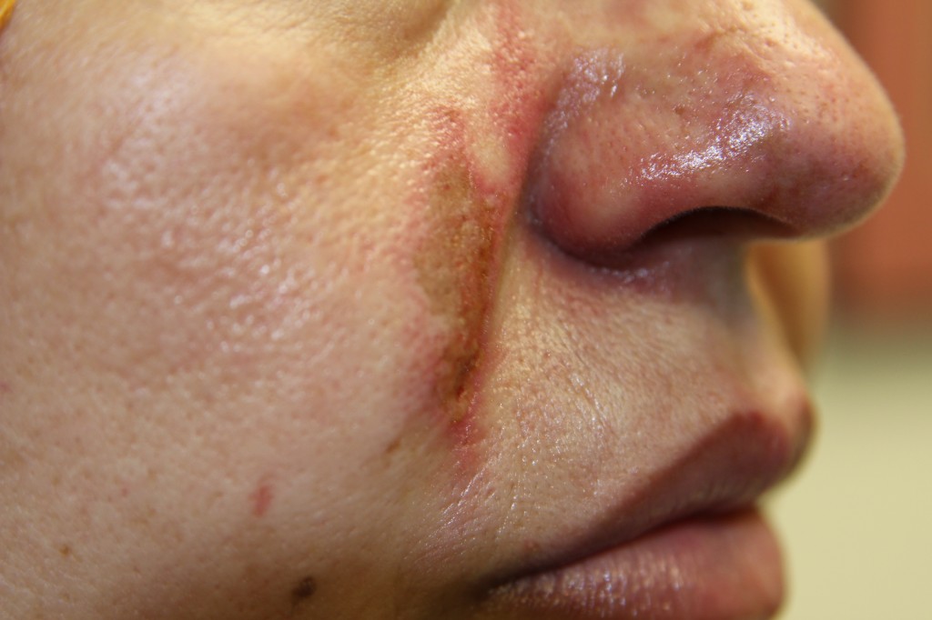 Accidental injection of Juvederm into a facial artery resulting in skin breakdown and compromise of blood flow to the cheek and nose