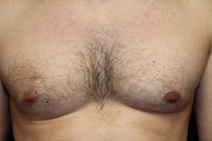 B) Left breast after surgery